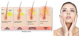 Mediklin Medi-Klin Medi Klin TR Clindamycin + Tretinoin Retinol Retinoic Vit A Cream FOR Inflamed Acne Vulgaris Lesion - HappyGreenStore